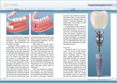 Implantat-Ratgeber 2 - Innenteil