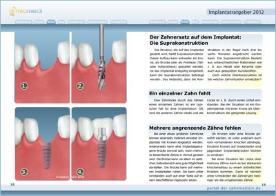 Implantat-Ratgeber 3 - Innenteil
