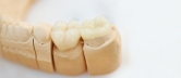 Implantate Zähne