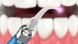 Dentallaser in der Zahnheilkunde – welche Vorteile bieten Laserbehandlungen?