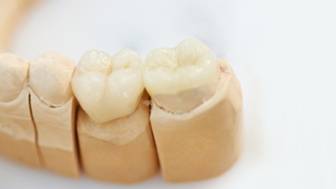 Implantate Zähne