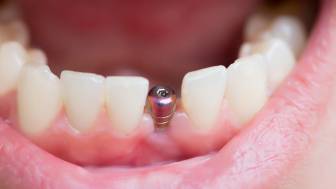 Implantate: Wie kann die Zahnzusatzversicherung finanziell unterstützen?