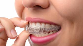 Invisalign® – die Alternative zur klassischen Zahnspange?