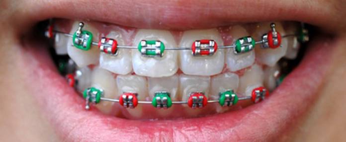 Kieferfehlstellungen, Zahnfehlstellungen, Fehlstellung der Zähne
