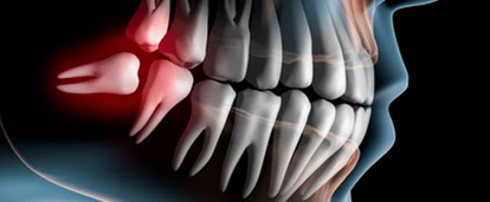 Plötzliche Zahnschmerzen: Was bis zum Zahnarzttermin hilft 