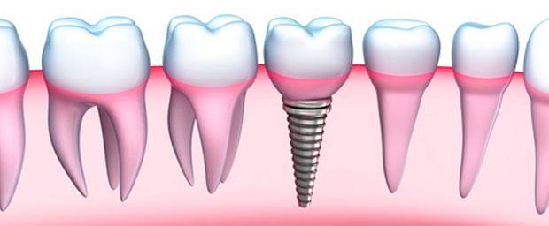52 Top Images Wann Wurzelbehandlung Nötig : Zahnnerv: Wann ist eine Wurzelspitzenresektion nötig ...